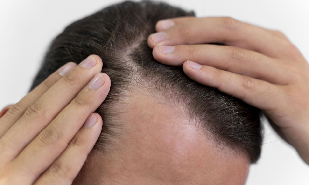 Understanding Hair Loss Causes and Solutions: A Comprehensive Guide